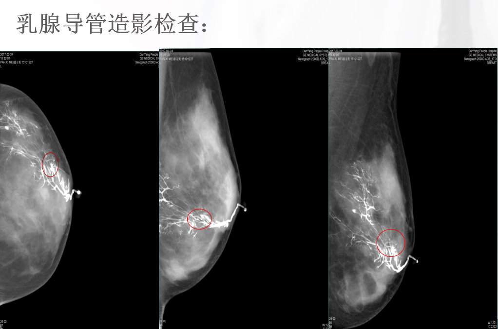 乳腺导管造影图片